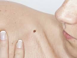 A white hair follicle bulb is not a cause of concern. Hairy Mole Removal Can You Pluck Mole Hair Black Hair And More
