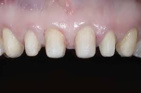 Jump to wood names beginning with. Facial View Of The Anterior Dentition Following Tooth Preparation For Download Scientific Diagram