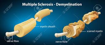 Multiple sclerosis (ms) information sheet compiled by the national institute of neurological disorders and stroke (ninds). Ilustracion Que Muestra La Esclerosis Multiple Ilustraciones Vectoriales Clip Art Vectorizado Libre De Derechos Image 20679993