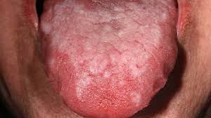 Read about the symptoms, duration, causes and remedies of the fever will occur as a result of the infection. Mouth Sores Pictures Causes Types Symptoms And Treatments