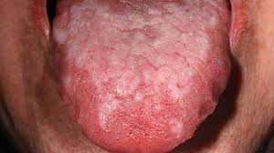 Check spelling or type a new query. Blood Blister In Mouth Causes Treatment Symptoms And More