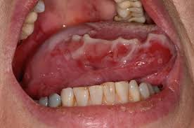Image result for Pemphigoid