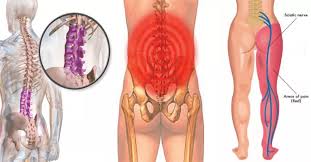 Pin On Back Pain