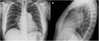 Abordaje de la hipertensión arterial pulmonar para el clínico:  fisiopatología, diagnóstico y tratamiento | REC: CardioClinics