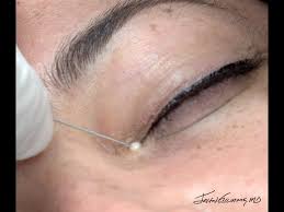 Image result for milium cyst on eyelid
