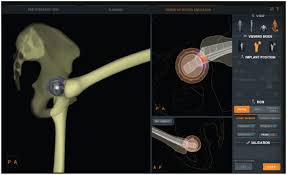 Three-dimensional pre-operative planning of primary hip arthroplasty: a  systematic literature review in: EFORT Open Reviews Volume 5 Issue 12 (2020)