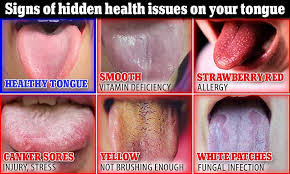 Image result for yellow tongue infection