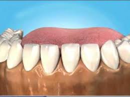 Baby teeth become very loose on their own and eventually fall out. Splinting Loose Teeth Youtube