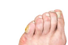 Bone spurs on the top of the foot can usually be palpated (felt) due to the fact that the skin is very thin on the top of the foot and there is virtually no muscle there either. Corn On The Pinky Toe Calluses Causes And Treatments Canyon Oaks
