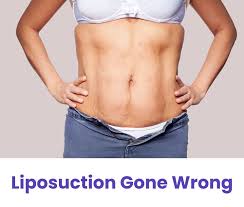 Image result for Liposuction