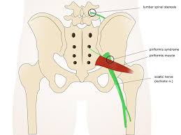 Schmerzen am oberschenkel innen (adduktorenschmerzen) plötzlich auftretende schmerzen an der innenseite des oberschenkels sind zu 99 prozent verletzungen der muskulatur. Starke Schmerzen In Gesass Beinen Und Rucken Das Piriformis Syndrom
