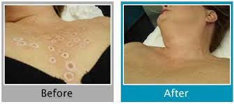 All prices listed are for single laser hair removal sessions for women. Permanent Hair Removal Vienna Virginia Before And After Permanent Hair Remover Procedure Bikini Hair Removal Leg Hair Removal Pubic Hair Removal Mygentlelase