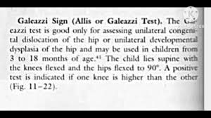 Image result for Galeazzi Sign