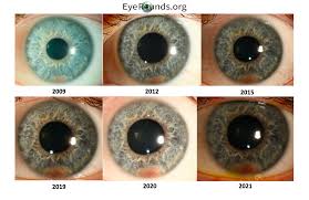 Image result for Hyphema