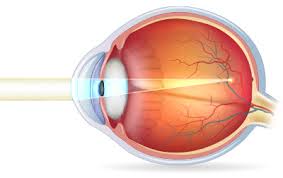 Image result for Refractive Error