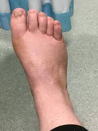Foot Still A Bit Swollen After 13 Weeks In Plaster Post Fracture After Surgery Fractures Surgery