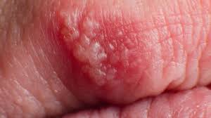 Ingrown hair causes pimples because of hair tunnels into the skin. Is It Herpes Or Something Else Everyday Health