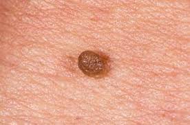 Image result for genital warts