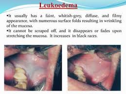 Image result for Leukoedema