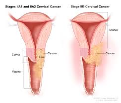 However, an enlarged uterus may signify uterine cancer if no other obvious cause for the enlargement is found. Cervical Cancer Pictures Of Cervical Cancer Stages Symptoms Diagnosis Cleveland H University Hospitals