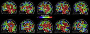 Bipolar disorder is a mental illness marked by extreme changes in mood from high to low, and from low to high. Accumulation Of Lithium In The Hippocampus Of Patients With Bipolar Disorder A Lithium 7 Magnetic Resonance Imaging Study At 7 Tesla Biological Psychiatry