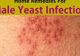Yeast infection bumps can evolve from a skin/genitals yeast infections caused by the overgrowth of candida yeast fungus in the body. Male Yeast Infections How To Diagnose Treat And Cure Your Yeast Infection So It Never Comes Back Amazon Co Uk Bryan Cox 9781450507318 Books Epicuriousmorsels Com