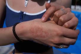 If you believe the rash is from an allergy or an irritant and appears mild, you can try a home remedy. Heat Rash Treatments Symptoms And Causes Healthdirect