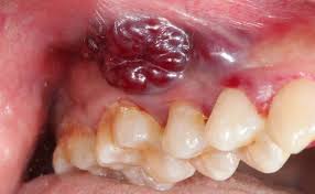 Any type of cancer can be scary if you are unaware of the facts. Oral Cancer Screenings Bronx Ny Your Bronx Dentist