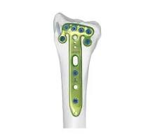 Distal Humeral Sub-condylar Locking Plate,Medical Device ...