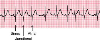 Image result for Extrasystole