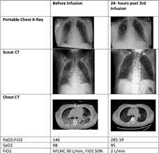 Rapid Clinical Recovery From Critical Covid-19 Pneumonia With Vasoactive  Intestinal Peptide Treatment - The Journal Of Heart And Lung Transplantation