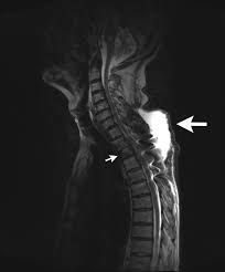 Msk lung cancer physicians include thoracic surgeons, medical oncologists, radiation oncologists, radiologists, and pathologists. A Fatal Case Of Spinal Tuberculosis Mistaken For Metastatic Lung Cancer Recalling Ancient Pott S Disease Annals Of Clinical Microbiology And Antimicrobials Full Text