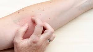 Intertrigo is a pink, red or brownish rash on the skin folds. á… Intertriginoses Ekzem Entstehung Symptome Und Behandlung Der Intertrigo