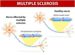 It interferes with your brain's ability to control your body. Multiple Sclerosis Symptoms And Treatment