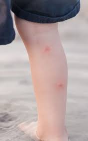 Les moustiques sont attirés par la transpiration. Quels Sont Les Symptomes Suite A Une Piqure