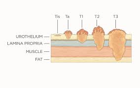 Image result for Bladder Cancer Staging