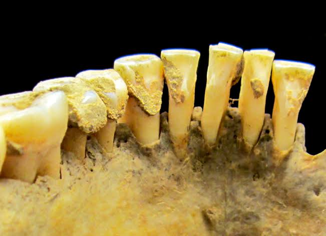 Dental calculus deposits preserving ancient DNA, AI generated