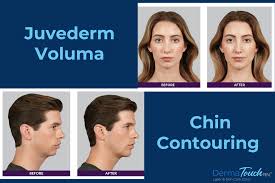 Facial Enhancement With Chin Contouring Dermal Filler Dermatouch Rn