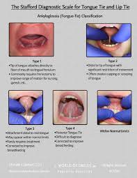 Diagnostic Scale For Lip And Tongue Tie Pediatric Dentist In Norwell Ma Hingham Pediatric Dentistry Dr Tongue Tie Pediatric Dentist Pediatric Dentistry