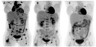 Novel Multimodal Management of Post-Partum Synchronous Metastatic Pulmonary  EBV-Associated Lymphoepithelioma-Like Carcinoma (LELC)&mdash;A Case Report