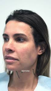 Pet Lift Face + Chin Lipo by Dr. DeSouza