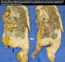 Incident cases of mesothelioma (n = 158), lung adenocarcinoma (n = 57) and associated nonmalignant pleural (n = 18), and pulmonary tissues (n = 52) were assessed for methylation (total n = 285).demographic and tumor characteristic data for these samples are presented in table 1.mean age and gender distributions were similar between tumor and their nontumor samples of origin. Pathology Basis Of Occupational Lung Disease Lung Cancer Niosh Cdc