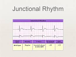 Occurs when the rate of an av junctional pacemaker exceeds that of the sinus node arises when there is increased automaticity in the av node coupled with decreased automaticity in the sinus node junctional rhythm classification by rate junctional escape rhythm: Ecg Interpretation Criteria Review Axis Deviation Left Right