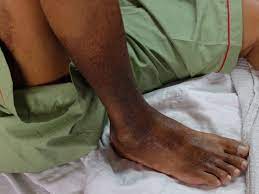 If this happens inside a person's body, including their leg, it can cause severe problems. What Causes Blood Clots Know Your Risks For Dvt And Pe