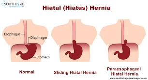 The opening is called the hiatus, so this condition is. Hiatal Hernia Causes Types Symptoms Diagnose And Treatment Texas