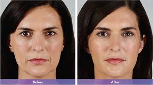 Fillers and Plumpers