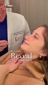 Revelación de Rinoplastia: Paciente Brindando Confianza