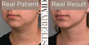 Sit on a chair with your back straight. Cheek Liposuction Buccal Fat Removal Reduce Chubby Face In Nyc Plastic Surgery News For New York City From Dr Thomas P Sterry