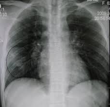 Image result for Pulmonary Contusion