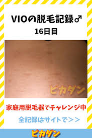 vio脱毛の記録16日目 毛深い30代男が家庭用脱毛器で挑戦中 脱毛器 脱毛 vio脱毛